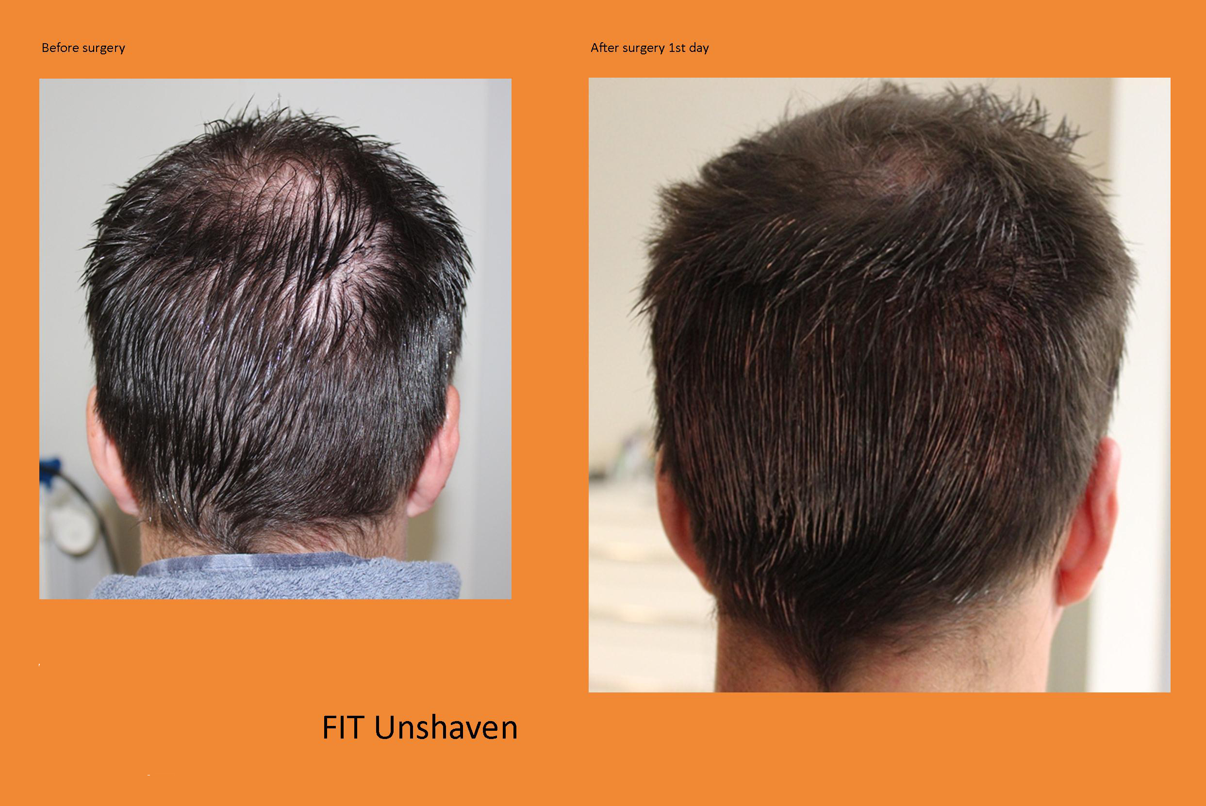 Unshaven Hair Transplantation Zero Shaving Example