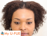 My U-FUE for women