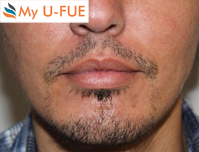 Beard Transplant