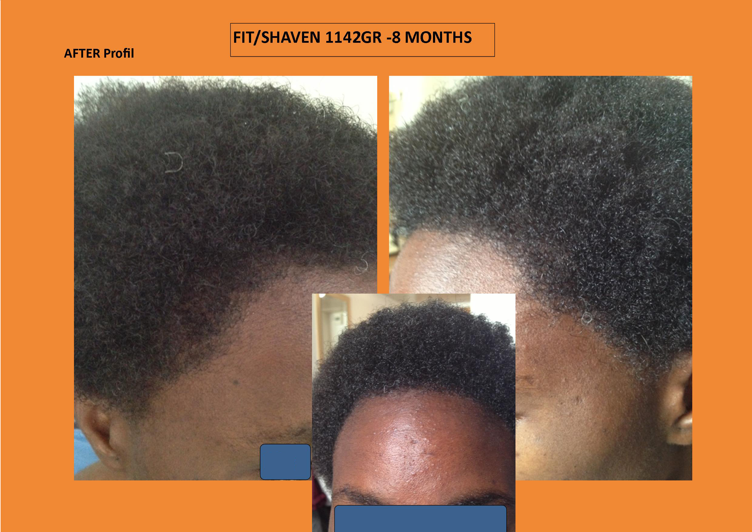 Curly hair, curls and africans black patients / WHTC Unshaven Non