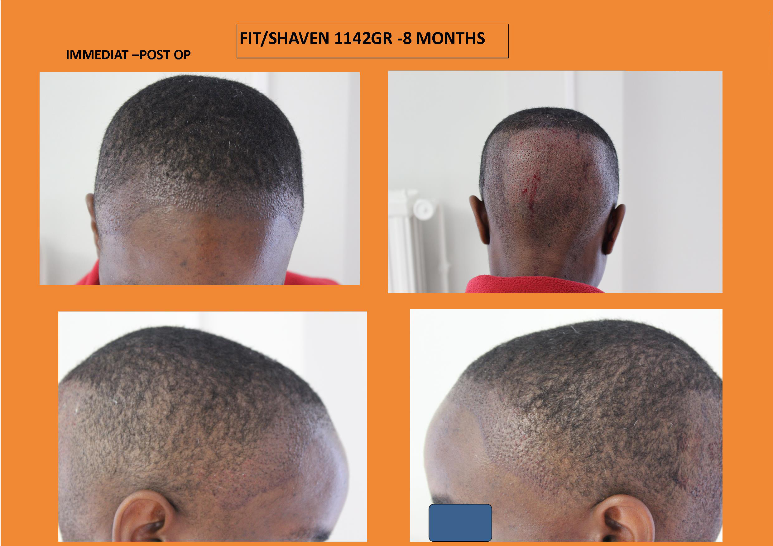 Curly hair, curls and africans black patients / WHTC Unshaven Non Shaven FUE Hair Transplant