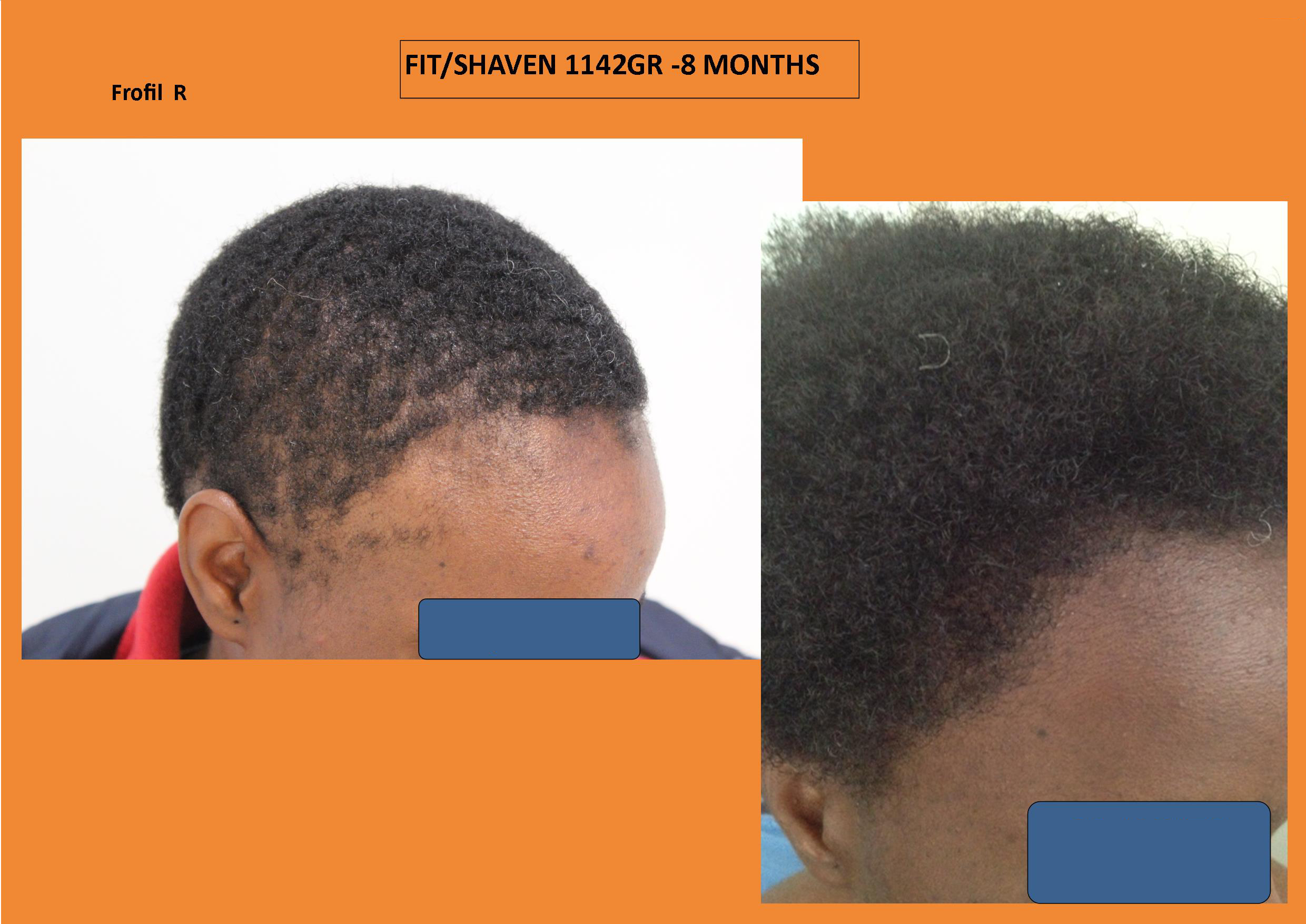 Curly hair, curls and africans black patients / WHTC Unshaven Non