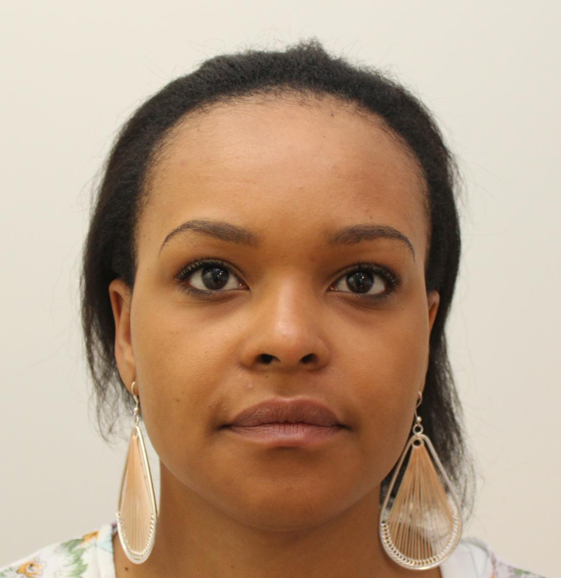 Hereditary hair loss in women Hereditary hair loss in women