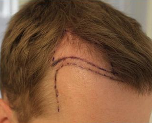 FUE Hair Transplant Receding Hairline and Temples no shave no shaving no short hair cut FUE Hair Transplant Receding Hairline and Temples no shave no shaving no short hair cut