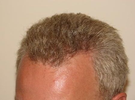 Profil links nach der OP