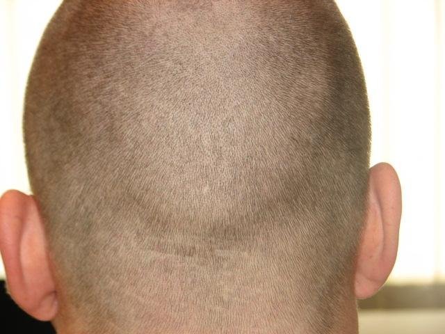 Donor healing 1