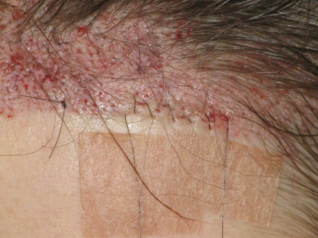 Hairline replacement left