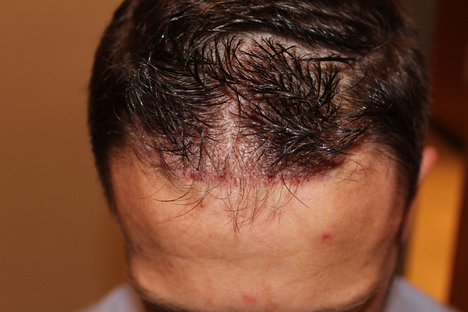 No Shave FUE Hair Transplant without shaving Head Technique Example