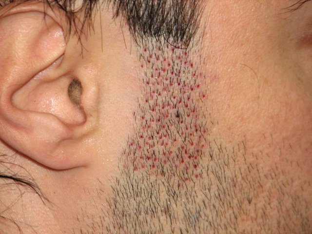 Side burn right before