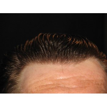 Result hairline