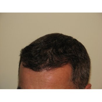 Result 6 months left dry hairs 