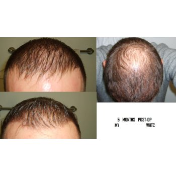 Result 5 months