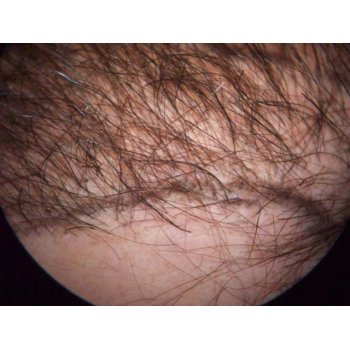 Hairline growth