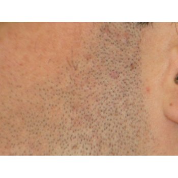 Side burn left after
