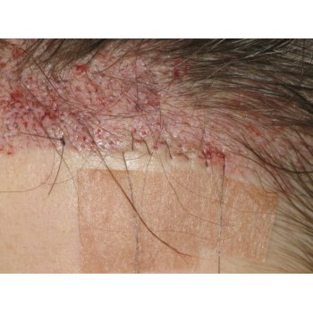 Hairline replacement left