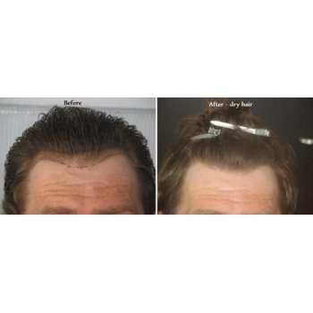 Before and after dry hairs 1 Before and after dry hairs 1